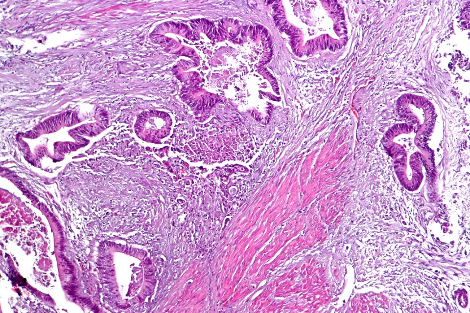 Adenocarcinoma_(intestinal_type)_of_the_urinary_bladder,_intermed._mag.3