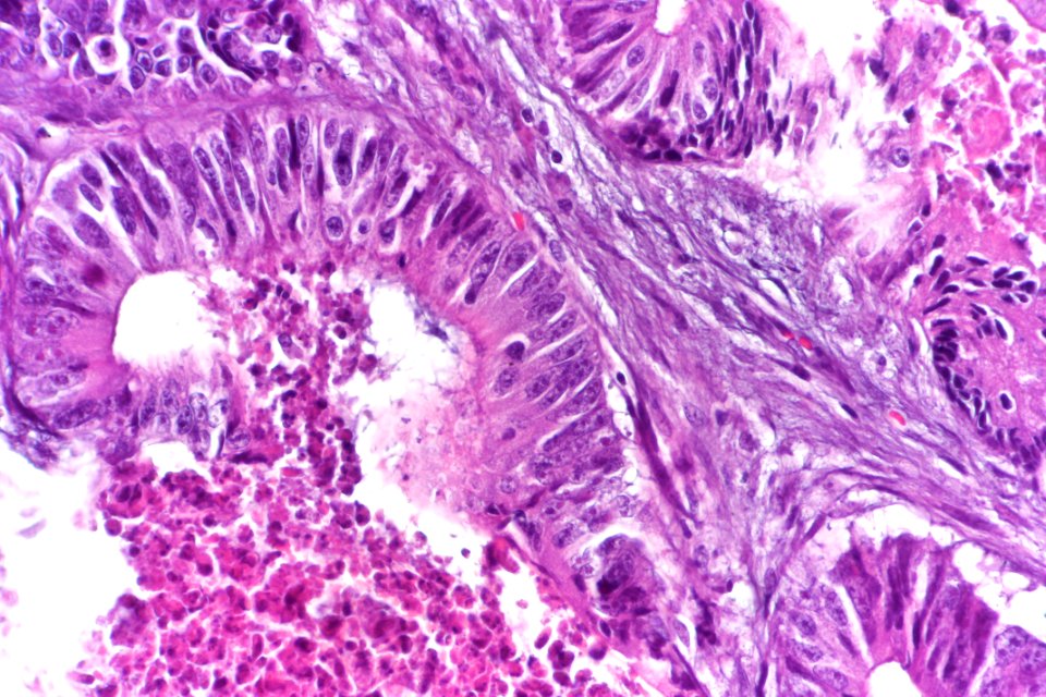 Adenocarcinoma_(intestinal_type)_of_the_urinary_bladder,_very_high_mag