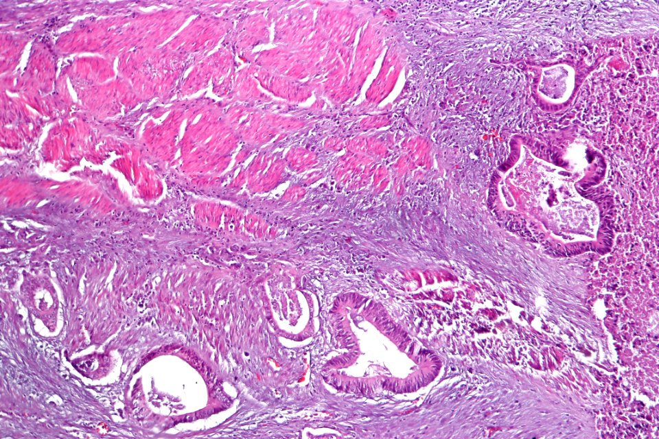 Adenocarcinoma_(intestinal_type)_of_the_urinary_bladder,_intermed._mag.4