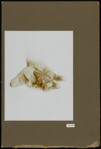 Beroepsziekte Aandoening aan hand, Bestanddeelnr 256-1553