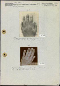 Beroepsziekte. Foto 1 Chromaatzweren aan de vingers (9x7 cm Fotograaf onbeken…, Bestanddeelnr 256-1935256-1936