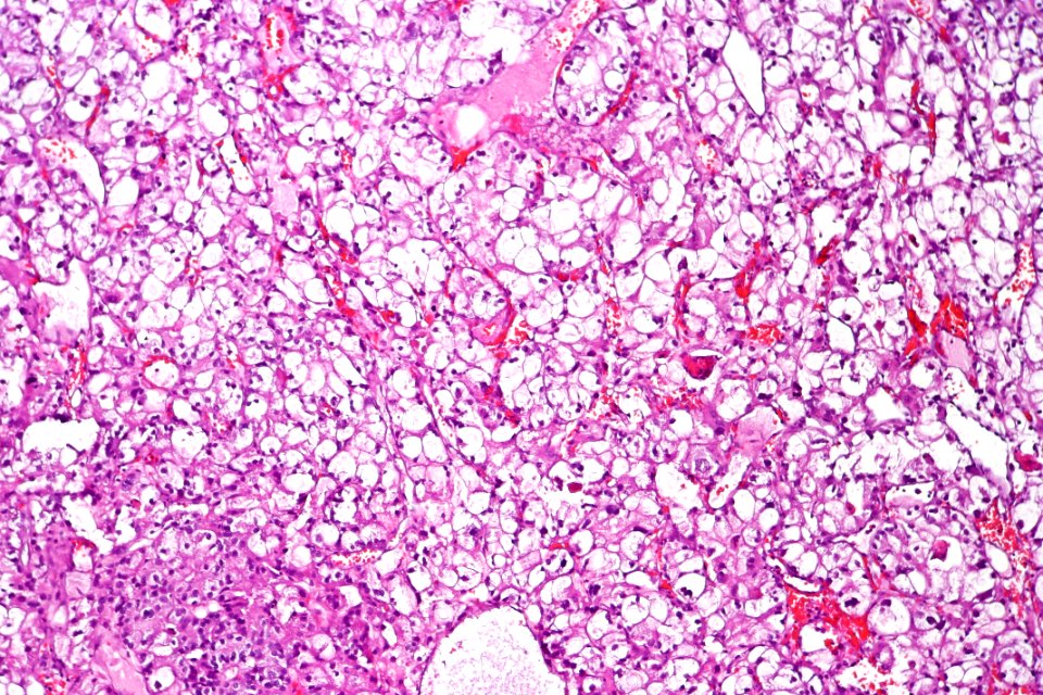 Clear cell urothelial carcinoma, intermed. mag