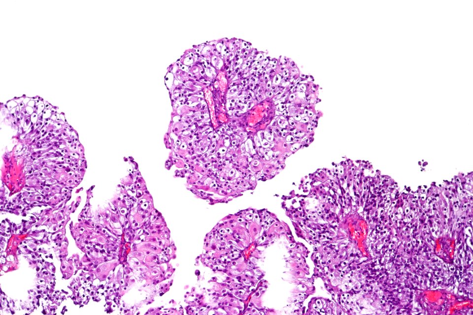 Clear cell papillary urothelial carcinoma, intermed. mag