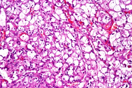 Clear cell urothelial carcinoma, high mag