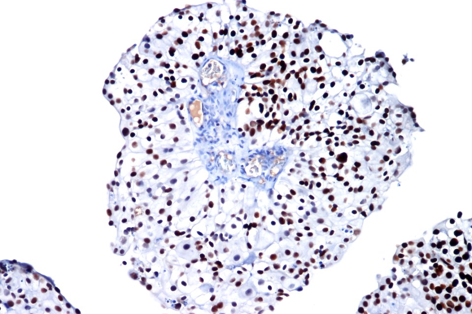 Clear cell urothelial carcinoma – GATA3, high mag