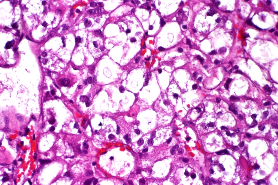 Clear cell urothelial carcinoma, very high mag