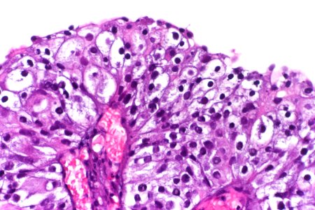 Clear cell papillary urothelial carcinoma, very high mag