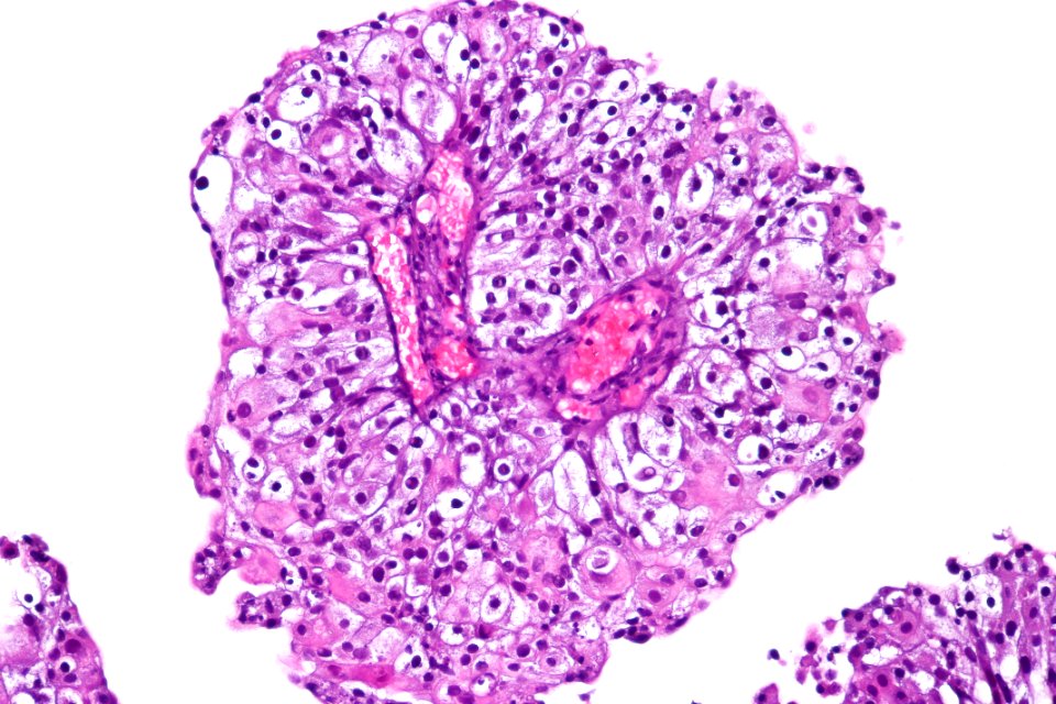 Clear cell papillary urothelial carcinoma, high mag
