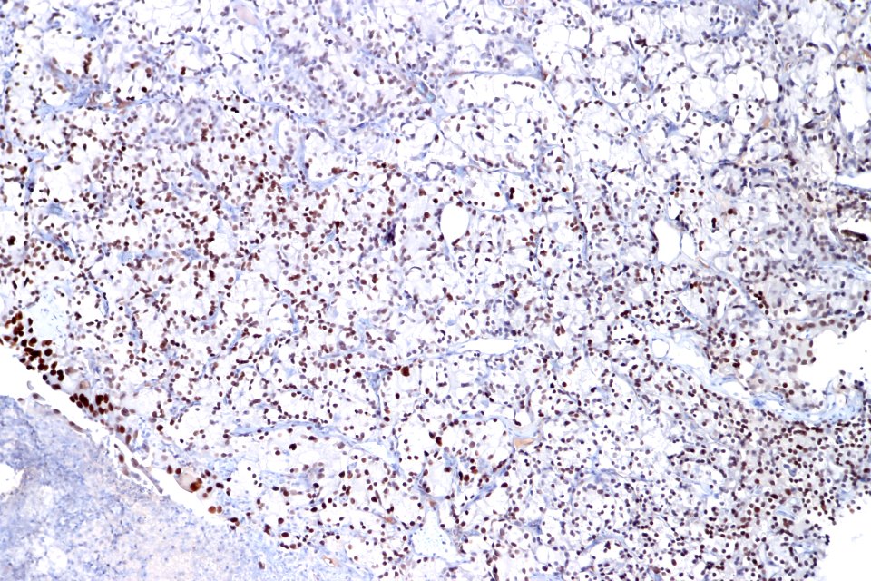Clear cell urothelial carcinoma – GATA3, intermed. mag