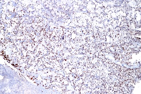 Clear cell urothelial carcinoma – GATA3, intermed. mag