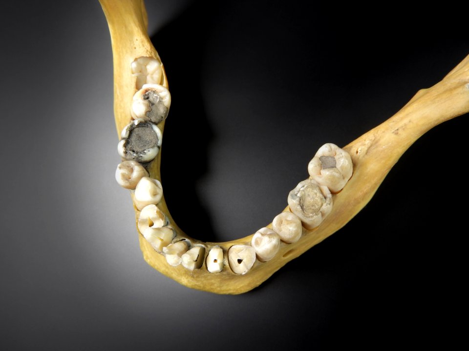 Cranium - mandibula (with dental filling, dentistry)
