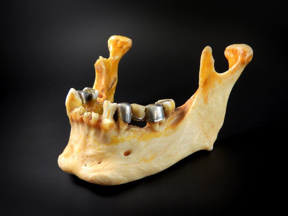 Cranium - mandibula (dental bridge, dentistry)