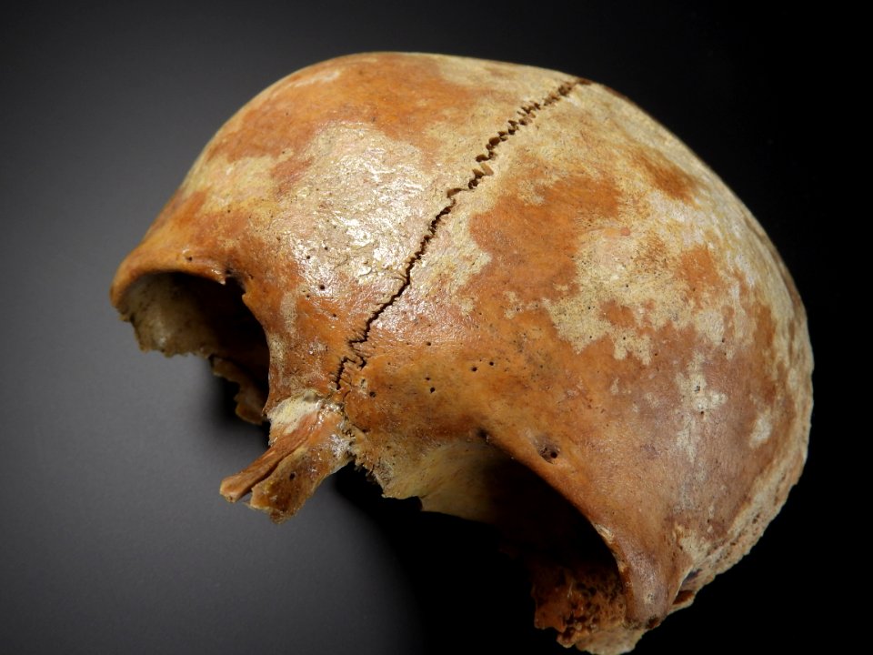 Cranium - sutura frontalis metopica