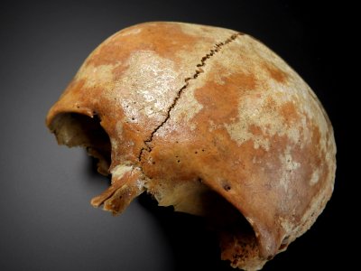 Cranium - sutura frontalis metopica