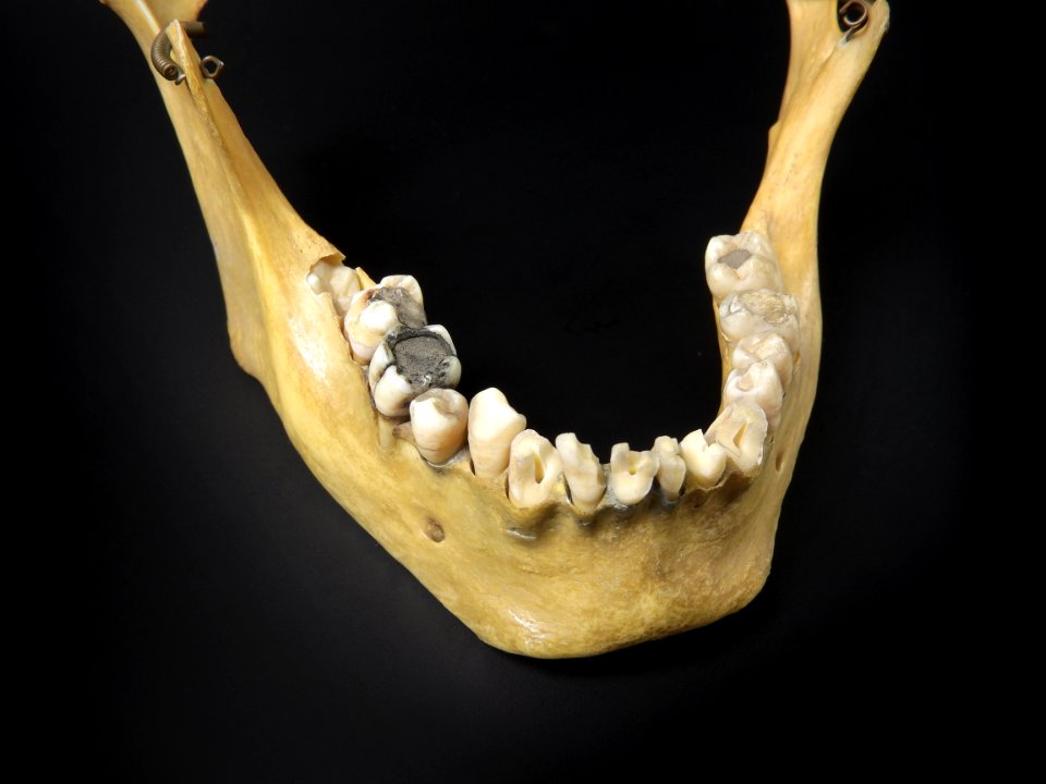 Cranium - mandibula (with dental filling, dentistry) 2