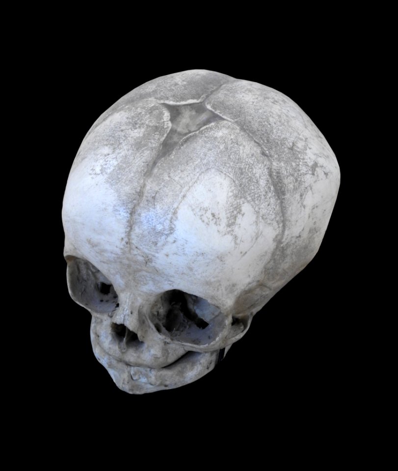 Cranium - baby, fontanel