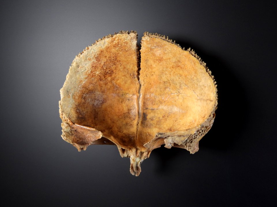 Cranium - sutura frontalis metopica (posterior)