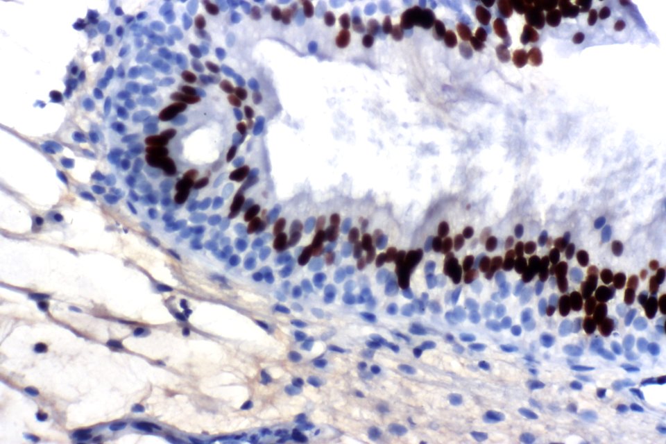 Cystitis glandularis usual type - CDX2, very high mag