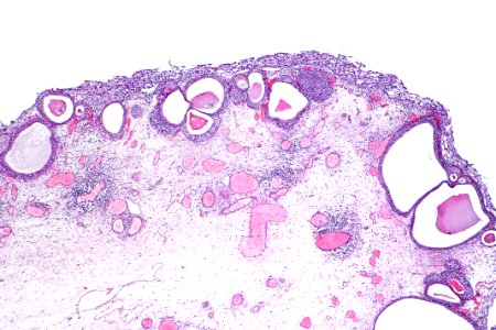Cystitis cystica et glandularis with urothelial carcinoma in situ, low mag.1