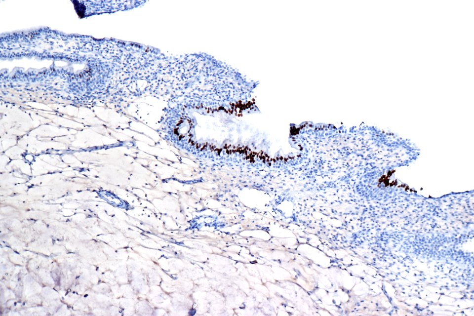 Cystitis glandularis usual type - CDX2, intermed. mag