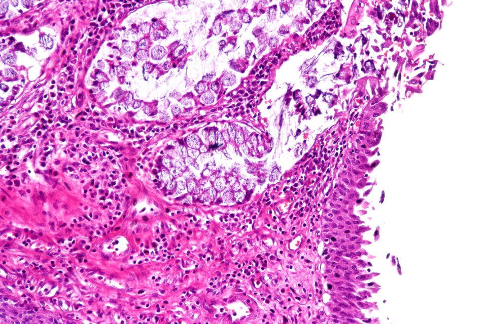 Cystitis glandularis intestinal type, high mag