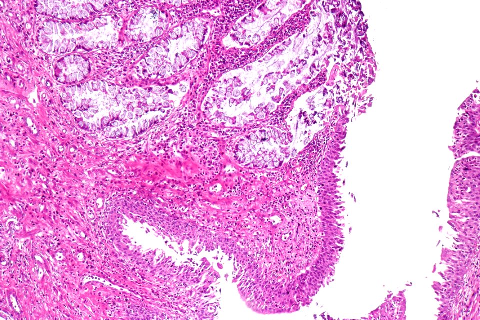 Cystitis glandularis intestinal type, intermed. mag
