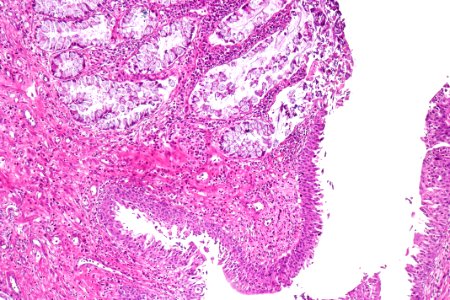 Cystitis glandularis intestinal type, intermed. mag