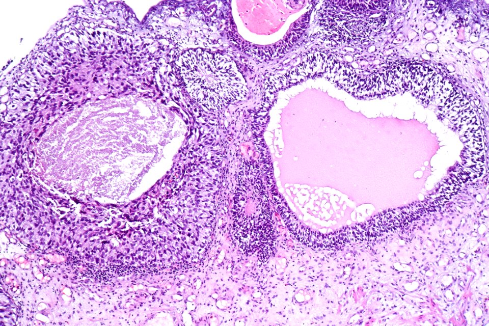 Cystitis cystica et glandularis with urothelial carcinoma in situ, intermed. mag.2