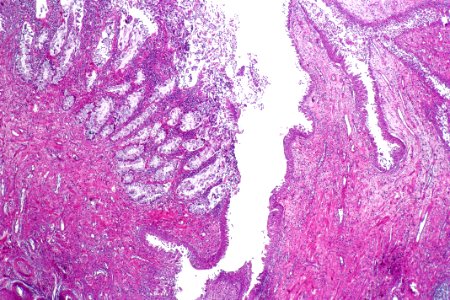 Cystitis glandularis intestinal type, low mag
