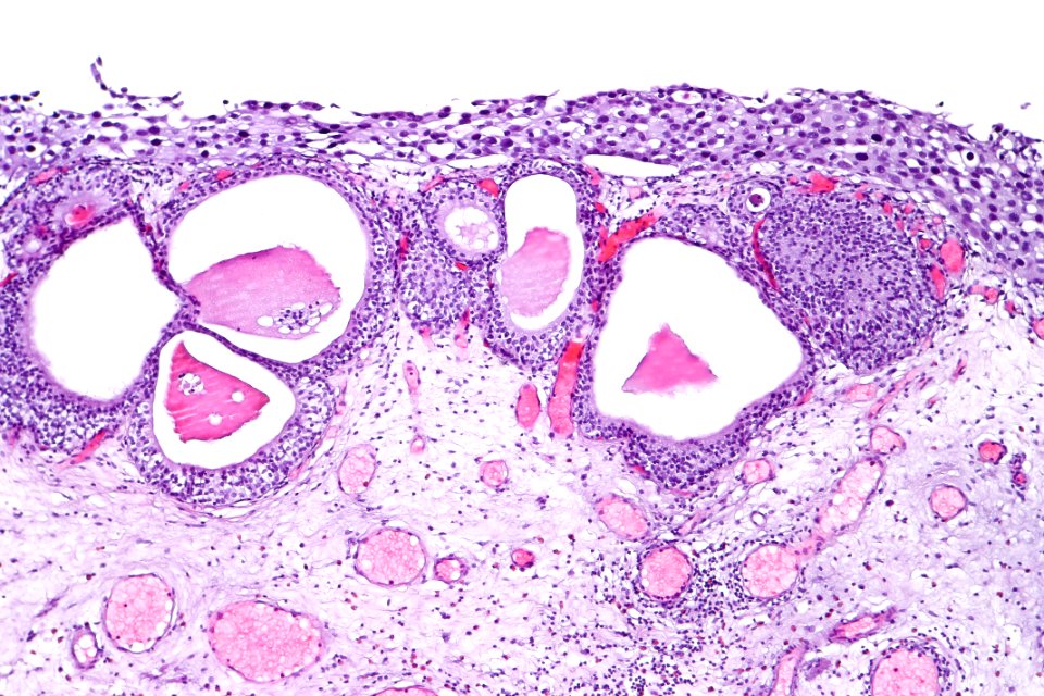 Cystitis cystica et glandularis with urothelial carcinoma in situ, intermed. mag.3