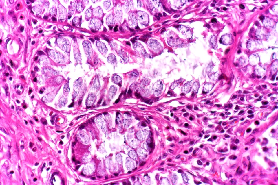 Cystitis glandularis intestinal type, very high mag