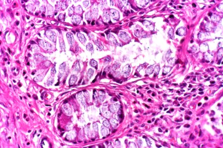 Cystitis glandularis intestinal type, very high mag