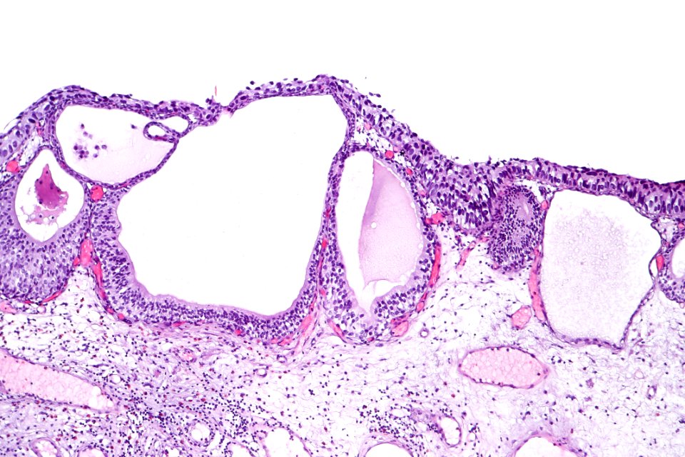 Cystitis cystica et glandularis with urothelial carcinoma in situ, intermed. mag.4