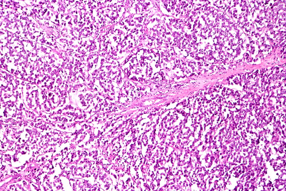 Dysgerminoma, intermed. mag.1
