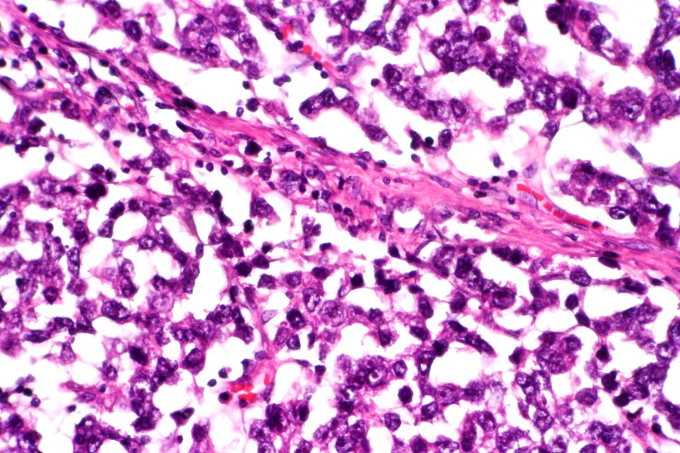 Dysgerminoma, very high mag.1