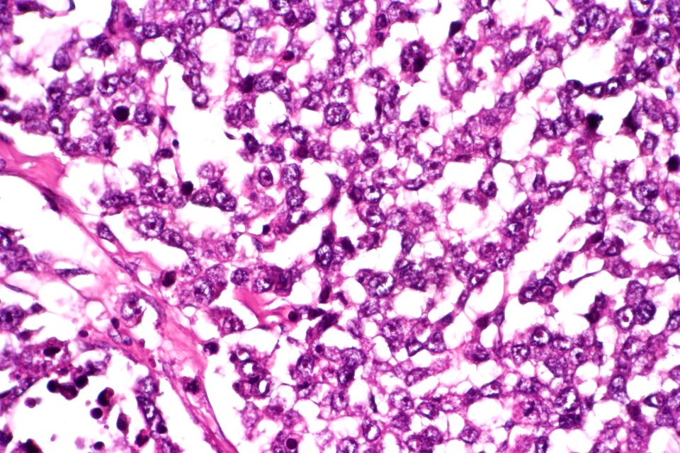 Dysgerminoma, very high mag.2