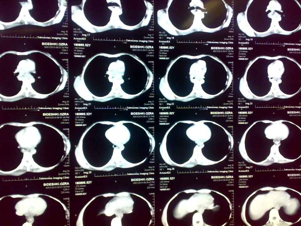 Esophagus Cancer 01