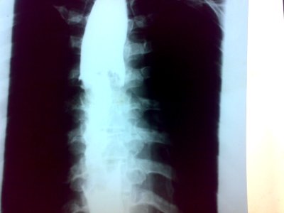 Esophagus Cancer 03