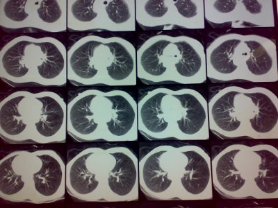 Esophagus Cancer