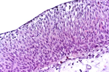 Flat urothelial hyperplasia, very high mag