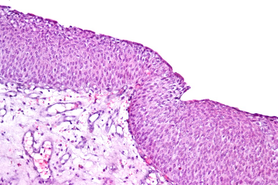 Flat urothelial hyperplasia, high mag