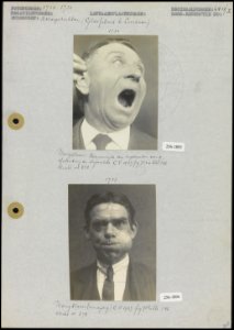 Foto 1 Binnenzijde van een ingezonken wang, afstoting van het slijmvlies van e…, Bestanddeelnr 256-1893256-1894
