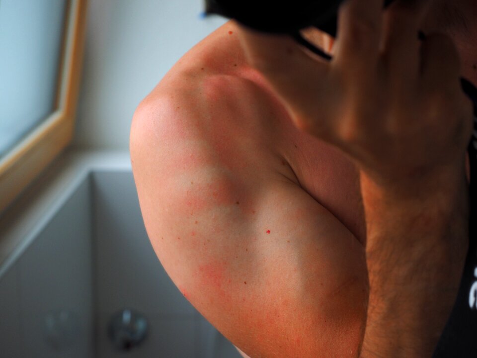 Flushed dermatology burned