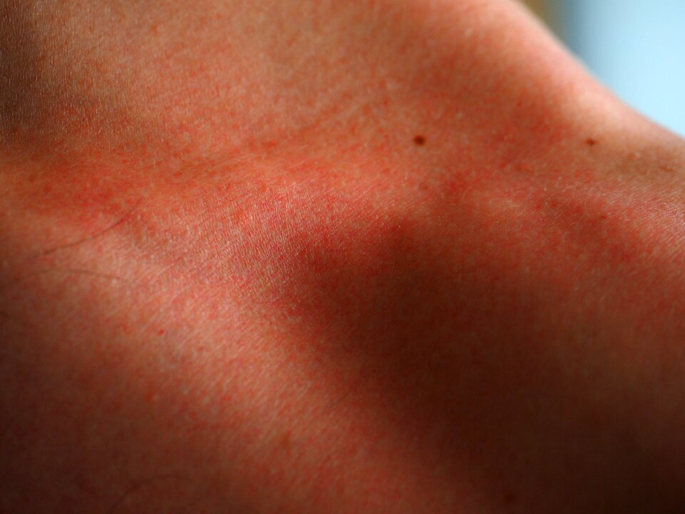 Flushed dermatology burned