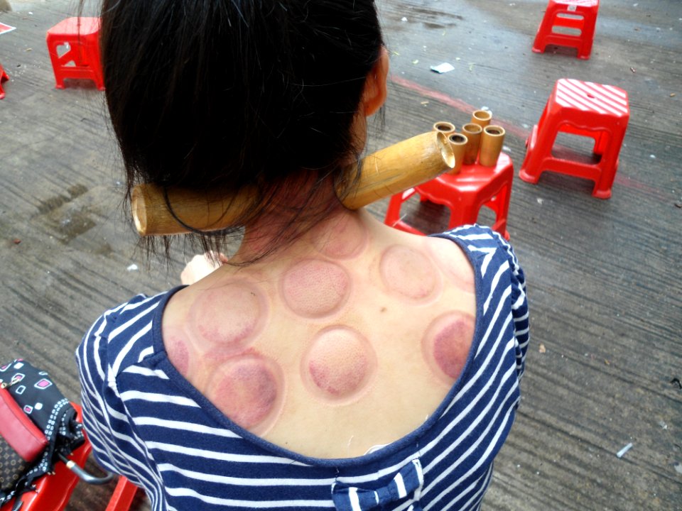 Fire cupping in Haikou - 03