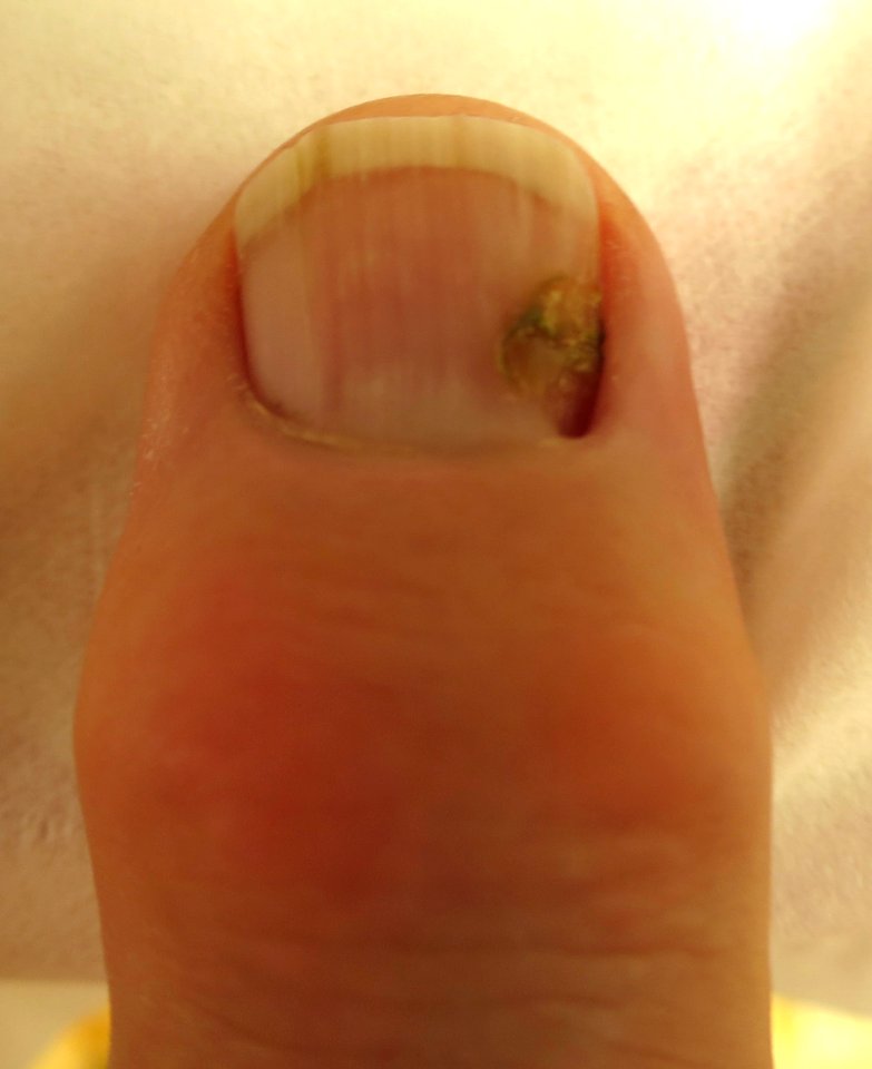 Finger nail after eradication of paronychia