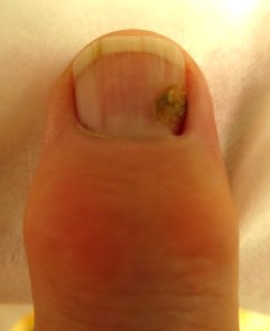 Finger nail after eradication of paronychia