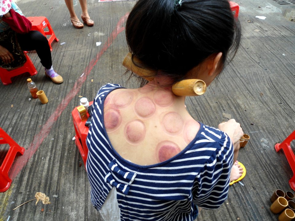 Fire cupping in Haikou - 02