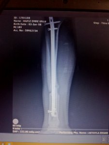 Fibula fracture photo