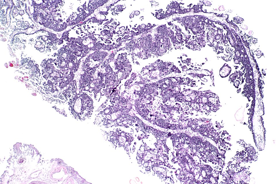 High-grade papillary urothelial carcinoma (EVG), low mag